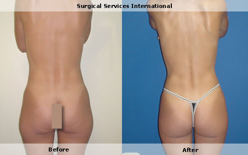 liposuction waist and thighs 